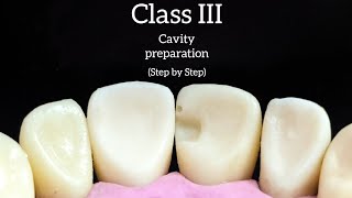 Class III cavity preparation step by step with explanation upper incisor  خطوة بخطوة مع الشرح [upl. by Letsyrk]