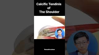 Staging of Calcific Tendinitis of the Shoulder [upl. by Tacita299]