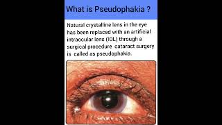 What is Pseudophakia  Optometry Fans [upl. by Lilas644]