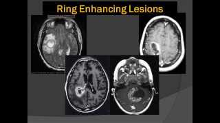 Brain Scans Lord of the Ring Enhancing Lesions 101 [upl. by Gernhard]