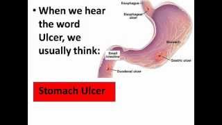 Decubitus Ulcers or Pressure Wounds [upl. by Brenn]