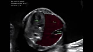 Hernie de la coupole diaphragmatique droite  fœtus âgé de 27 SA [upl. by Egide]