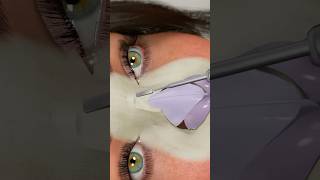 Rhinoplasty in 15 seconds [upl. by Niddala]