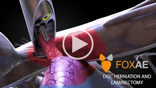 Laminectomy  Legal Animation  Surgery Demonstration [upl. by Hadleigh]