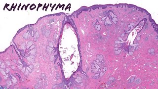 Rhinophyma large nose due to severe rosacea plus Demodex mites [upl. by Odab]