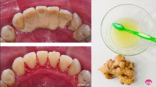 How to Remove Tartar from Teeth at home naturally  Natural Ways to Remove Tartar Buildup [upl. by Yeldnarb]