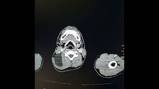 Lymphangioma along right side of neck and upper posterior thorax [upl. by Lleunamme978]