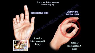 Anterior Interosseous Nerve Injury  Everything You Need To Know  Dr Nabil Ebraheim [upl. by Inamik]