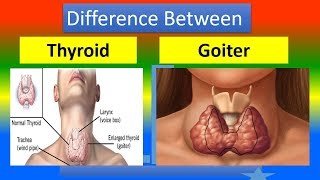 DIFFERENCE BETWEEN THYROID AND GOITER [upl. by Ahsikyt]