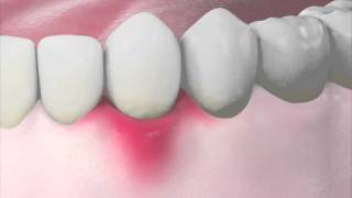 The stages of periodontal disease [upl. by Candice]