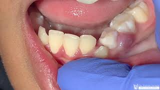 Severe Gum Abscess In A 10 Year Old [upl. by Terra358]