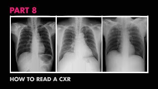 Diaphragms and Pleural Effusion  How to Read a Chest XRay Part 8  MEDZCOOL [upl. by Marissa]