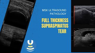 Full thickness Supraspinatus tendon tear on ultrasound [upl. by Siol]