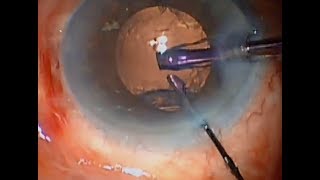 Capsular Tension Ring CTR Insertion for Zonule Loss [upl. by Stulin]