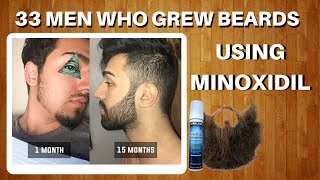 33 Men Who Grew Beards Using Minoxidil  The Minox Beard Spot  Minoxidil Beard Showcase [upl. by Sieracki762]