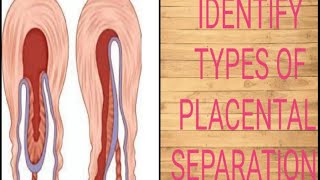 placenta amp its method of separation [upl. by Rinna]