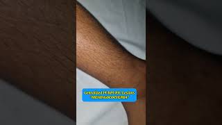 Meningococcemia Rash  Purpura fulminans  Purpuric Rash rash pediatrics doctor [upl. by Anawek]