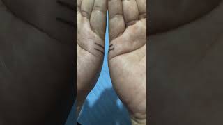 Two parallel marriage lines Palmistry PalmReading [upl. by Jilleen530]