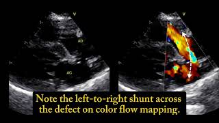 Ostium secundum atrial septal defect a 6 monthold cat 🐱 [upl. by Eiramlehcar418]