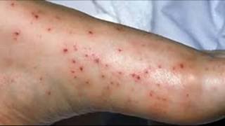 How to Treat Pinpoint Petechiae [upl. by Ranit17]