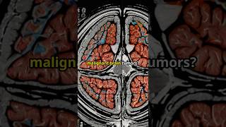 Causeless mercy amp benign and malignant brain tumors kneetie stroke ADHD dubaitelemedicine [upl. by Edmondo]