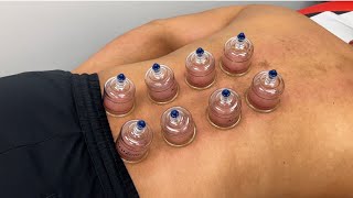 Cupping Lower Back  Chinese cupping therapy to relieve Lower Back pain [upl. by Carling]