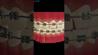 Dental Trivia  Dental Braces Process  Best Dental Braces in Hatibagan dentalhygiene [upl. by Massiw]