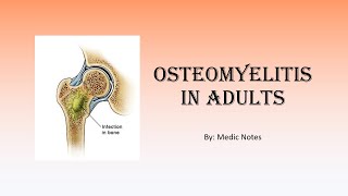 Osteomyelitis in adults  causes symptoms classification investigations treatment complications [upl. by Wane]