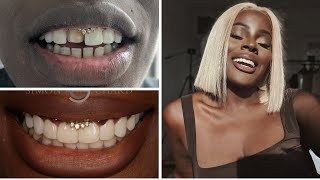 HOW I FIXED MY TEETH WITHOUT VENEERS ALL QUESTIONS ANSWERED  VIDEOS [upl. by Araid]