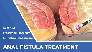 Closure of Fistula Tract with Laser [upl. by Sej289]