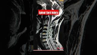 Spinal Cord Injury Explained shorts ytshorts mri medicine [upl. by Tenaj]