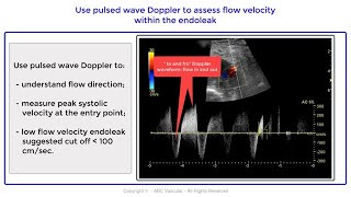 High jet velocities type II endoleak post endovascular abdominal aortic aneurysm repair EVAR [upl. by Hassadah]