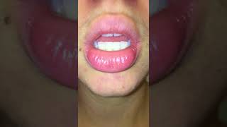 exfoliative cheilitis  day 0 pre treatment  tacrolimus amp burts bees wax hand salve [upl. by Packer]