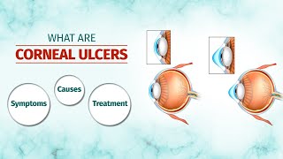 What are Corneal Ulcers Symptoms Causes Treatment Options and More [upl. by Heisel]