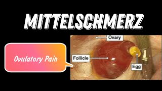 MittelSchmerz  Ovulatory Pain  Midcycle Pain  MisMedicine [upl. by Auric]