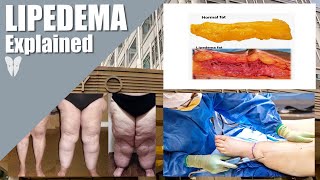 What is Lipedema and How is Lipedema Treated  Total Lipedema Care  Dr Jaime Schwartz [upl. by Cairns]