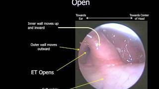 Eustachian Tube Dysfunction  ETD [upl. by Corotto]