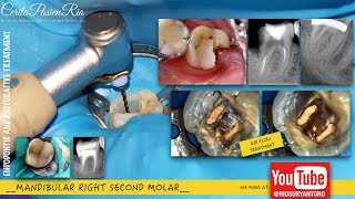 warm vertical compaction endodontic root canal treatment  perawatan saluran akar [upl. by Tati]