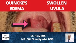 Swelling of uvula  Quincke Edema  Angioneurotic oedema  Uvula Functions  Causes  Management [upl. by Emilio878]