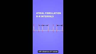 Atrial Fibrillation vs Atrial Flutter under 30 seconds [upl. by Apilef]