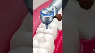 ASMR cavity treatment asmr asmrvideo shorts short shortvideo shortsvideo shortsfeed shots [upl. by Oigroig499]