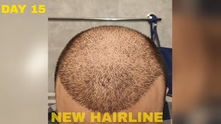 Hair Transplant Results DAY 15 FUE Turkey [upl. by Welch548]