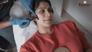 മുഖ സൗന്ദര്യത്തിനു ലേസർ ചികിത്സ Face Laser Treatment  Novocare [upl. by Nileak439]