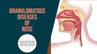 GRANULOMATOUS DISEASES OF NOSE part 3 mucormycosis wegeners granulomatosis in detail [upl. by D'Arcy]