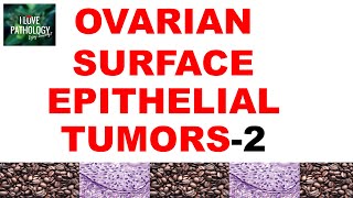 OVARIAN TUMORS  Part 3  ENDOMETRIOID CLEAR CELL amp BRENNER TUMOR Pathology [upl. by Amandie]