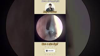 귀지형 콧물 부비동염 축농증 비염 코청소 이비인후과 rhinorrhea rhinitis sinusitis asmr [upl. by Rhtaeh]