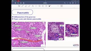 Pathology Hepatobiliary system 5 [upl. by Ahselet]