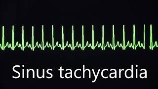 Sinus rhythm bradycardia and tachycardia [upl. by Xet]