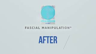 BEFORE amp AFTER FASCIAL MANIPULATION 1 [upl. by Hpseoj]