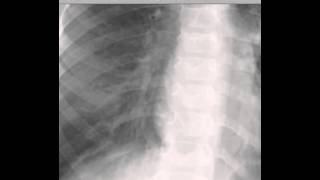 Pediatric Chest Xray Pneumonia DISCUSSION by Radiologist [upl. by Anegroeg]